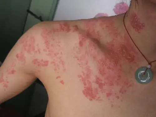 带状疱疹一例 - 皮肤及性传播疾病讨论版 - 爱爱医医学论坛