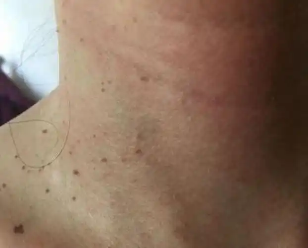 丝状疣的对比图片