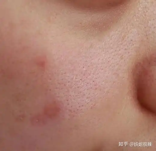 熬夜痘,姨妈痘痘,统统消光光!