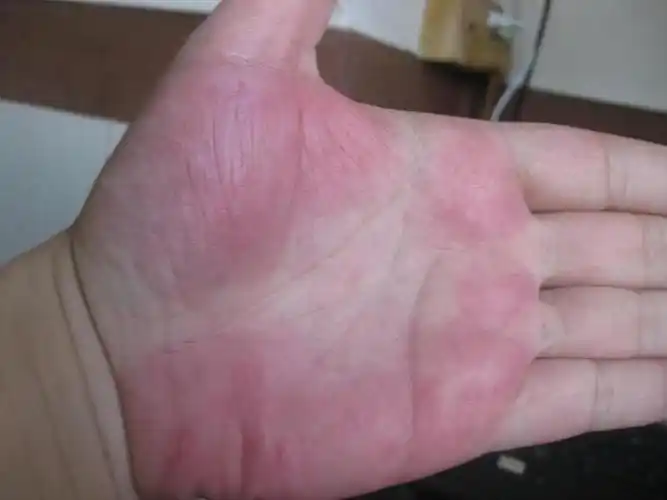 胃癌并非说来就来!手部出现的4种情况,已经在暗示癌症的来临