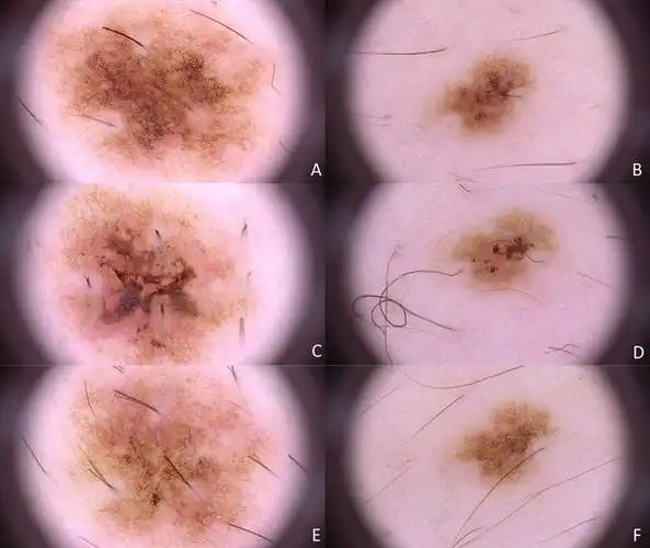 强脉冲光治疗后色素痣皮肤镜表现的改变