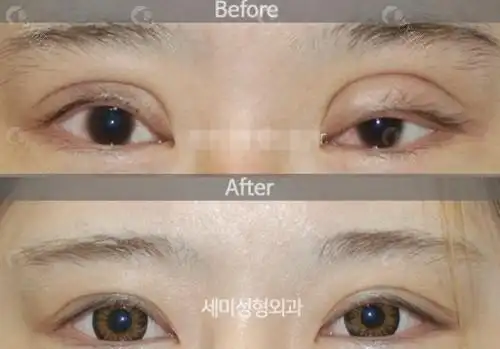 韩国世美整形外科双眼皮修复对比图