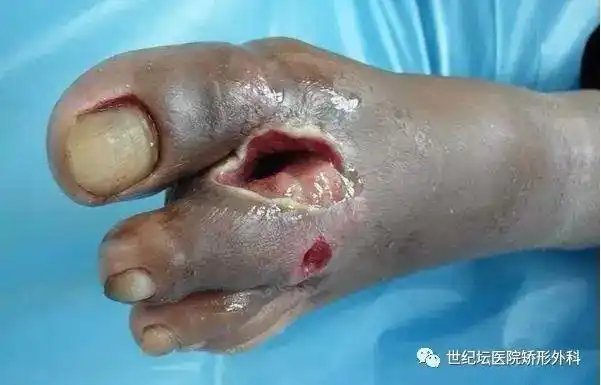 糖尿病足截肢