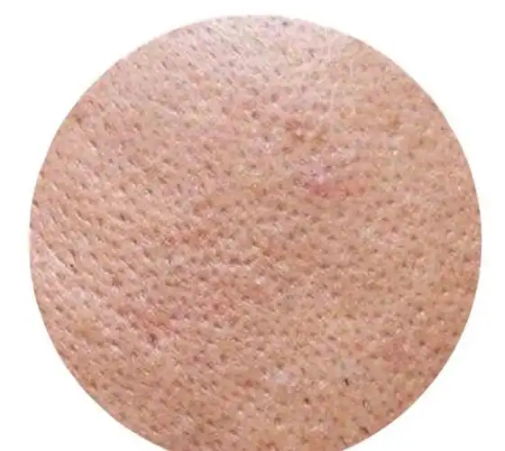 ③ 干燥型毛孔粗大——水光补水