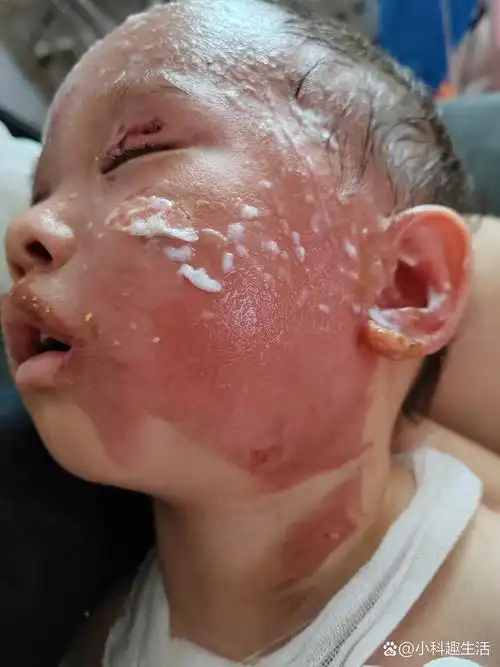 孩子烫伤恢复
