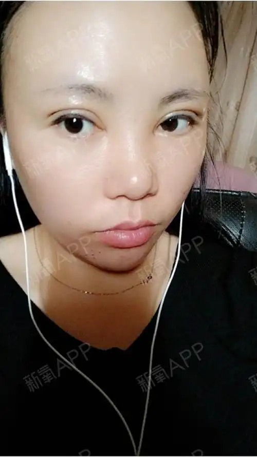 佛山埋线双眼皮好不好_效果图_芊芊蔓蔓埋线双眼皮术后第10天_新氧