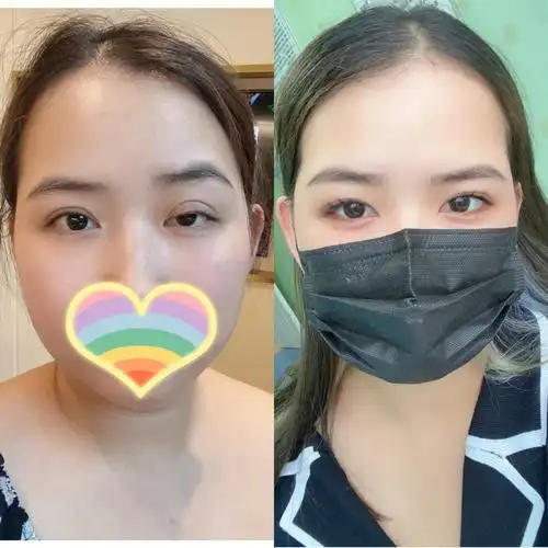 孔宇上睑下垂修复7天拆线啦