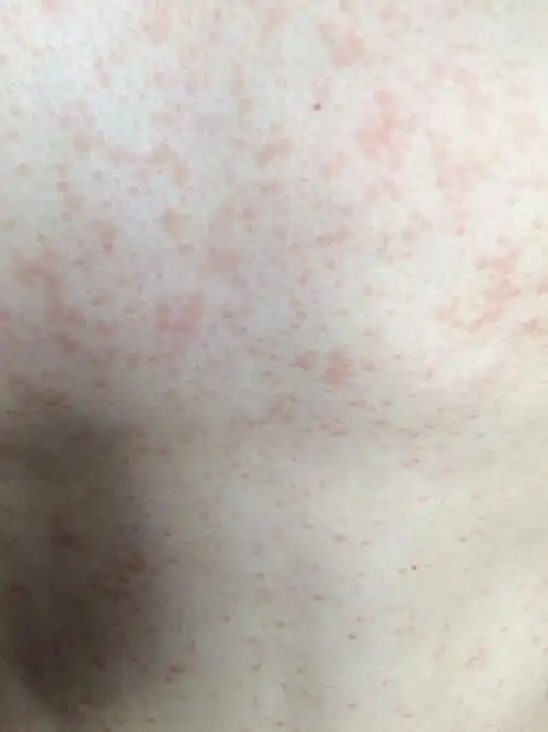 身上长了红色疹子,但是不痛不痒,请问这是什么回事?