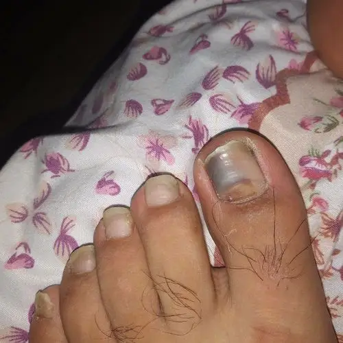 我的脚趾变得很黑.