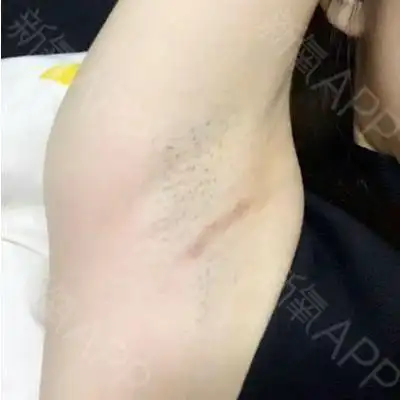 随着时间过去手感越来越自然了,腋下的伤口也恢复的很_圈子-新氧美容