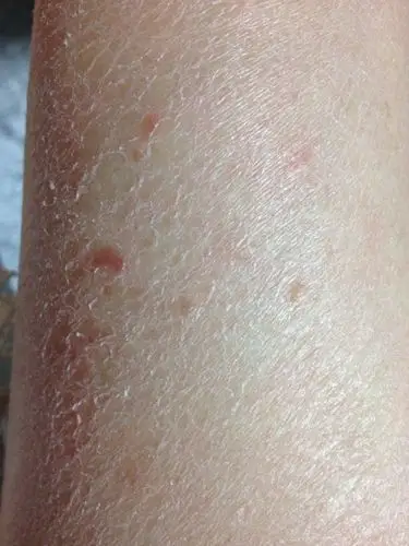 2014-11-30  问医生 浏览官网  展开全部 经常这样需要考虑干燥性皮炎