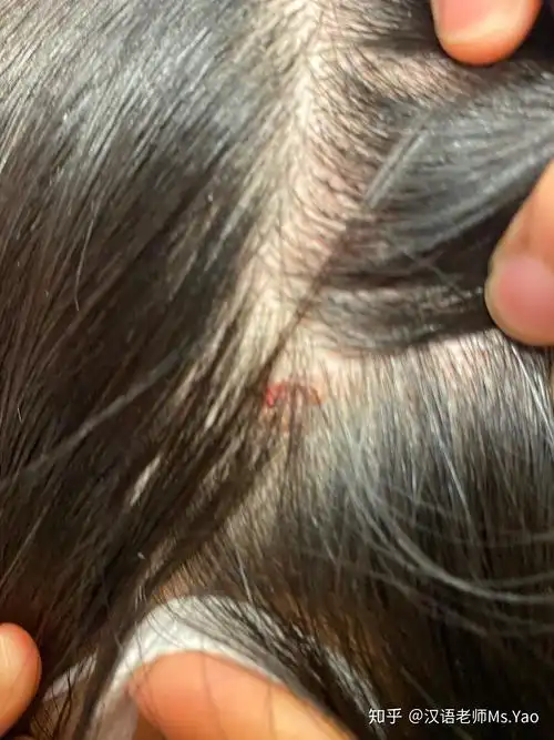 一直挠头头上有许多结痂怎么能不挠这是怎么回事而且挠完扣下结痂会有
