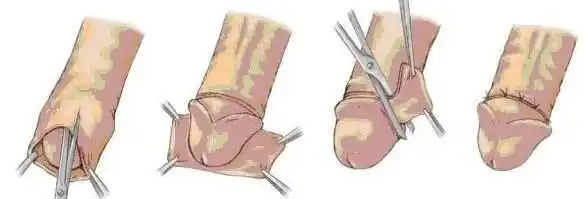 男性生殖器畸形之常见包皮手术方式之比较_包皮过长_治疗方式_治疗