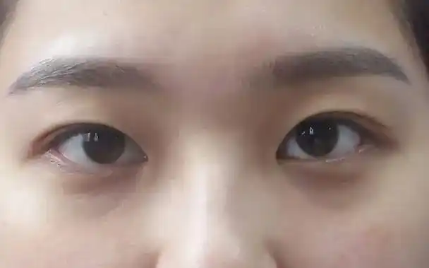 内双可以做哪种双眼皮手术