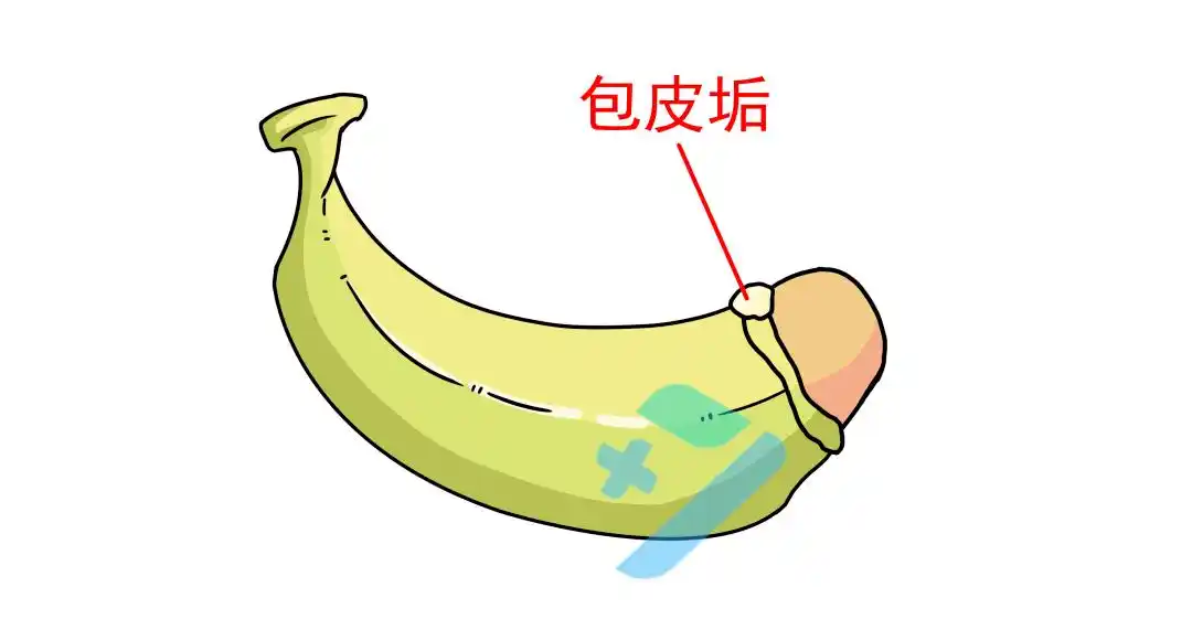 男娃包茎,包皮过长,不及时处理,真的很危险!_龟头_割包皮_阴茎