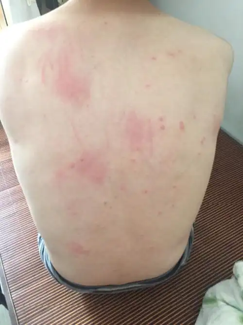 背上出了许多小红点,很痒,是什么情况,过敏?还是跳蚤?因为家里有_百度
