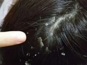 屑过多的原因也有很多,比如头皮脂溢性皮炎(与马拉色菌关系密切),干性