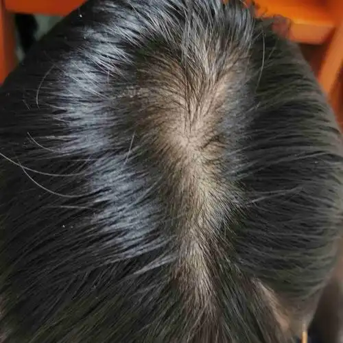 我这算秃顶吗.怎么治?