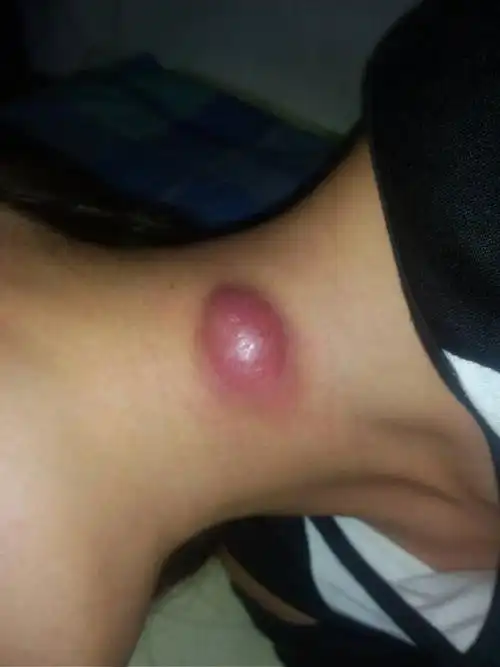 脖子上长了一个大脓包 严重不严重 已经一星期左右 在北京中医医院开