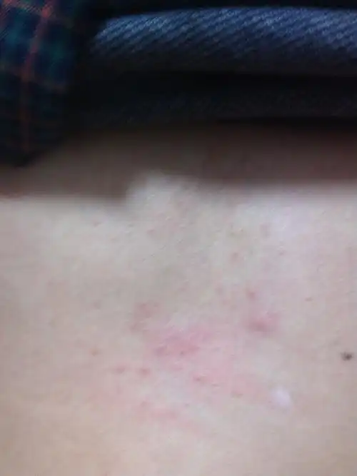 男性胸口出现红色疙瘩,是什么病啊,为何会起?求帮忙啊!