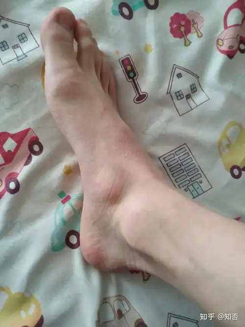 左边脚还好,右边脚哪里的骨头为啥突出来了,这是什么情况啊?