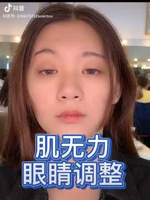 肌无力眼睛调整肌无力蒜头大叔