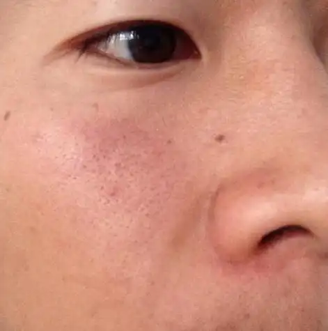 弄的毛孔粗大,怎么办?