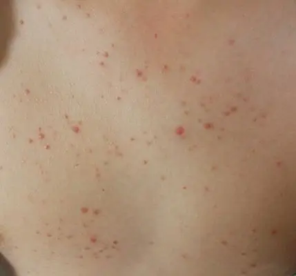 艾滋病红点图片 (8)