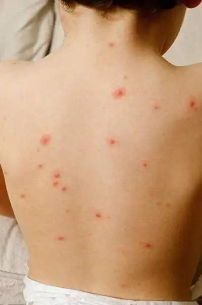 小孩水痘症状图片62