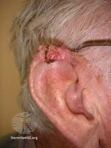 孩子总是挠耳朵,怀疑是耳道湿疹,可以滴眼药水吗?