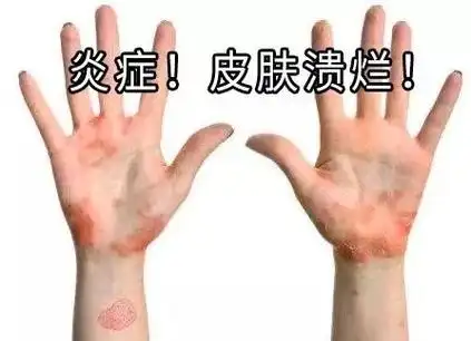 湿疹反复?那你是没遇到它!|皮炎|瘙痒|皮肤病|过敏_网易订阅