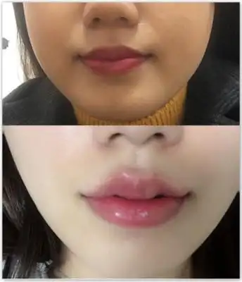 韩国maypure玻尿酸丰唇案例对比