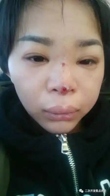 举报一女孩在宣化整容却被毁容实名举报卫生局女孩们引以为戒