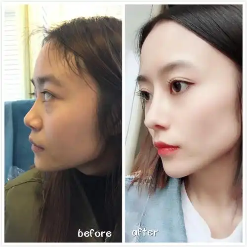 耳软骨鼻部多项整形前后对比▼