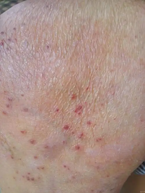 今天的病人,皮疹不痛不痒 - 皮肤及性传播疾病讨论版 - 爱爱医医学