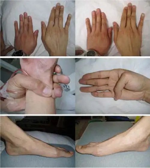 此病也叫蜘蛛指症.