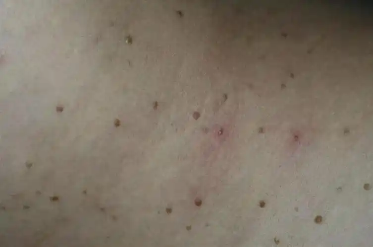 妻子染hpv不自知,1月后丈夫满身疣体,为何男人更严重?听医生怎么说