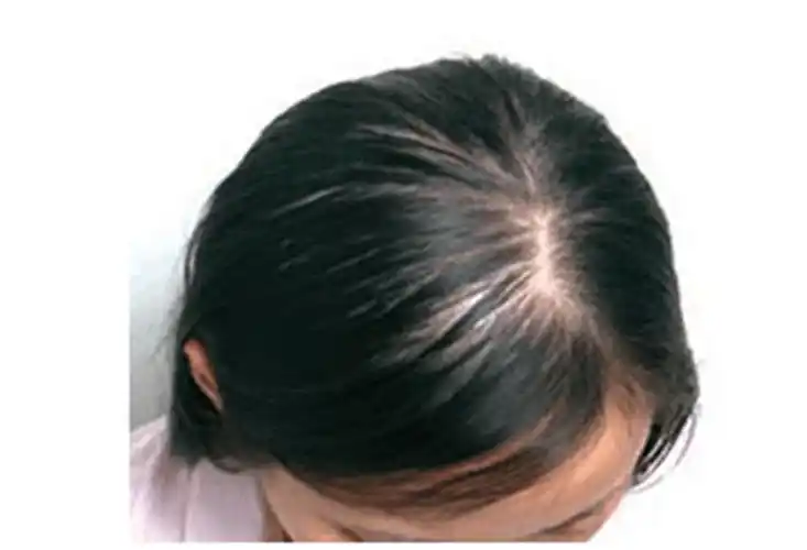 产后脱发严重! 好担心秃顶, 这正常吗?