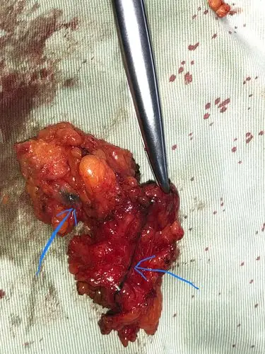 中心医院肿瘤外二科开展乳腺癌前哨淋巴结活检术