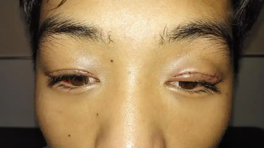 cfs治疗上睑下垂达到很满意的效果 - 好大夫在线