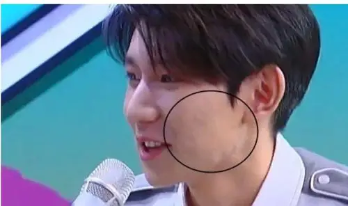 王源长残?脸上痘痘越来越严重,连化妆品和美颜都拯救不了他!