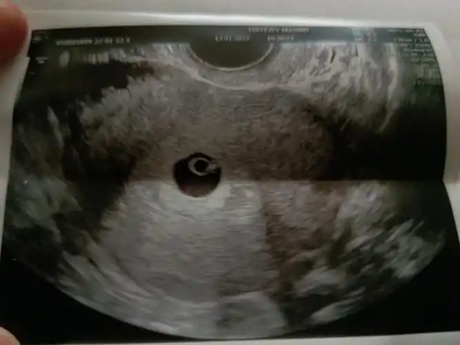 热乎的胎心胎芽