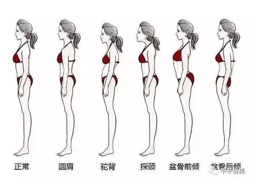 脖子前倾,骨盆倾斜