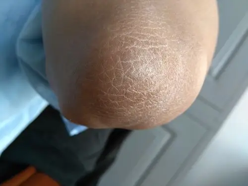 胳膊肘皮肤变成这样怎么回事?