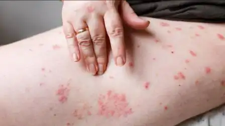 "身体"长湿疹,是怎么回事?提醒:治疗不是洗洗那么简单