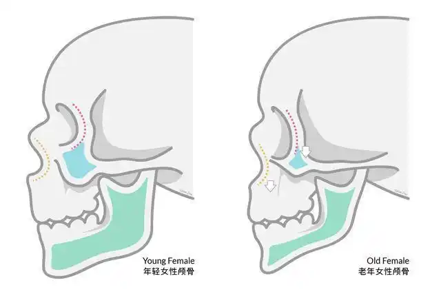 微创面部提升抗衰效果如何?适合哪些人?可以改善哪些问题呢?