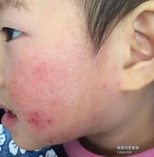 两年多了!n种食物过敏!