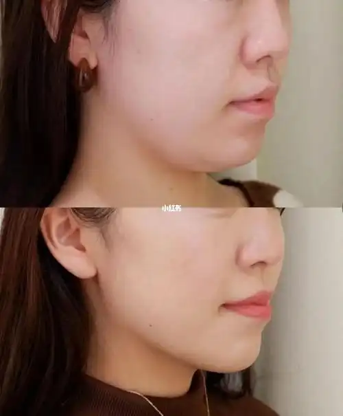玻尿酸 保妥适 下颌缘提升,一个月效果我觉得已经完美了,气质提升了