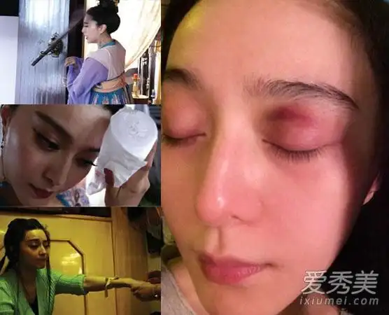 范冰冰柳岩范玮琪 12位女星意外受伤毁容照