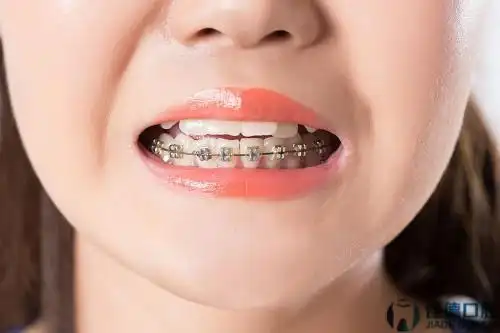 合肥小孩牙齿地包天矫正?